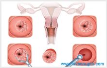 Những biến chứng nguy hiểm của bệnh viêm lộ tuyến cổ tử cung