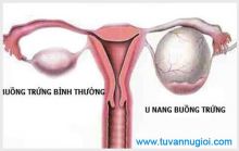 Nguyên nhân gây ra bệnh u nang buồng trứng tphcm
