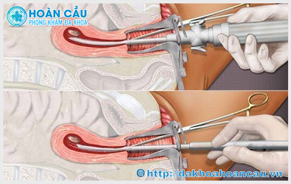 Phương pháp hút thai bằng chân không