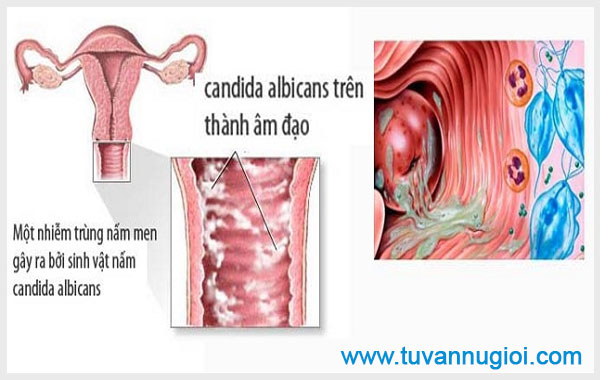 Ngứa âm đạo có thể tái phát nếu điều trị không đúng cách