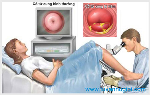 Cách điều trị viêm cổ tử cung hiệu quả