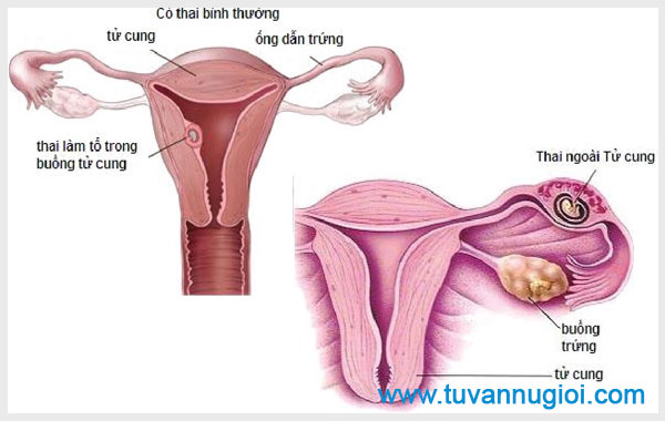 Tỷ lệ nữ giới mắc tắc ống dẫn trứng đang ngày một tăng cao