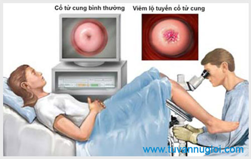 Điều trị viêm lộ tuyến cổ tử cung ở đâu tốt nhất tại TPHCM ?