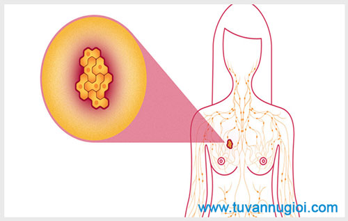 Những triệu chứng, dấu hiệu của bệnh ung thư vú