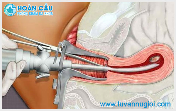 [TPHCM] Phá thai 11 tuần có nguy hiểm không? Thực hiện bằng phương pháp nào an toàn