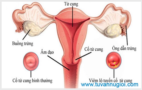 Phụ nữ sau khi sinh nở nhiều dễ mắc bệnh viêm lộ tuyến cổ tử cung