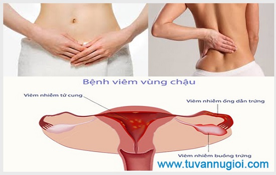 Viêm vùng chậu gây nhiều nguy hiểm cho người bệnh