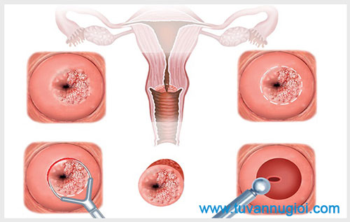 Triệu chứng và cách điều trị viêm cổ tử cung mãn tính