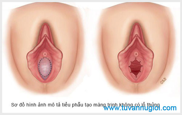 Hình ảnh màng trinh với nhiều lỗ thoát máu kinh của nữ giới