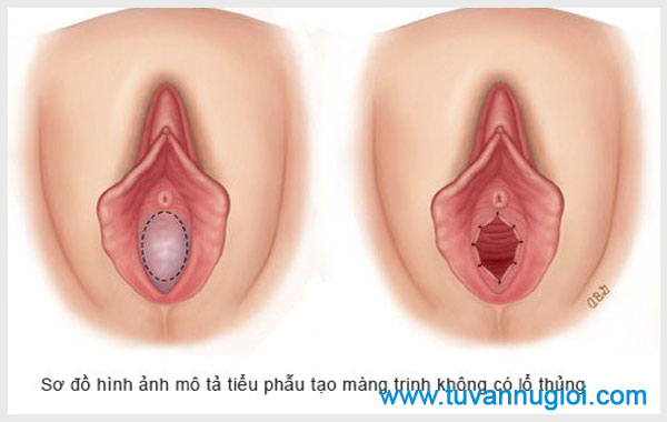 Một số hình ảnh về màng trinh