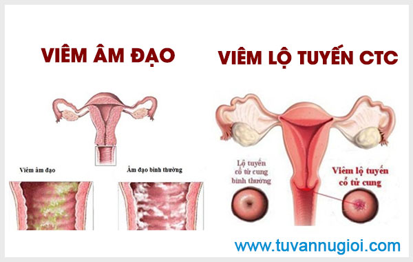 Hình ảnh nhận biết bệnh viêm âm đạo và viêm lộ tuyến cổ tử cung ở nữ giới