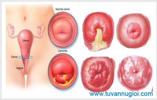 Viêm lộ tuyến toàn bộ cổ tử cung gây nhiều nguy hiểm