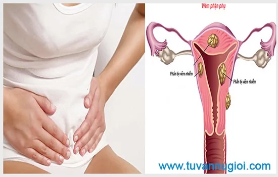 Cần sớm phát hiện triệu chứng viêm phần phụ