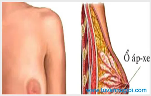 Apxe vú là bệnh gì và khám ở đâu thì tốt nhất tại Tphcm ?