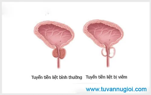 Bệnh viêm tuyến tiền liệt có nguy hiểm không?