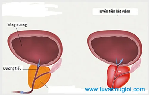 Bệnh viêm tuyến tiền liệt có nguy hiểm không?