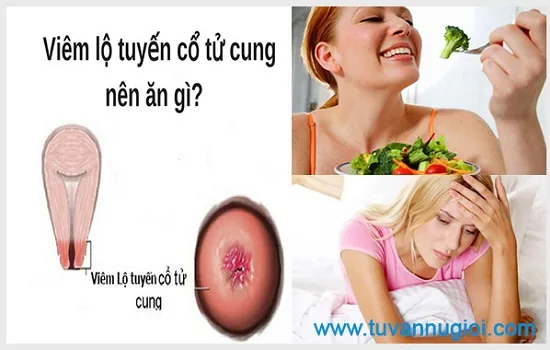 Bệnh nhân bị viêm lộ tuyến cần thực hiện chế độ ăn uống phù hợp