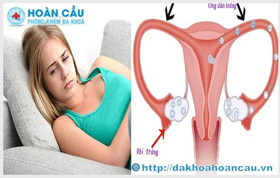 Viêm phần phụ là nỗi ám ảnh của nhiều người
