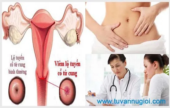 Cần điều trị viêm lộ tuyến tại cơ sở uy tín