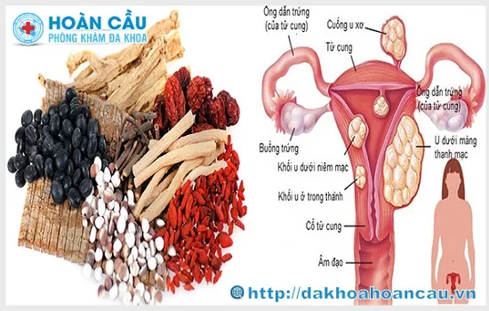 Cần sớm điều trị viêm phần phụ