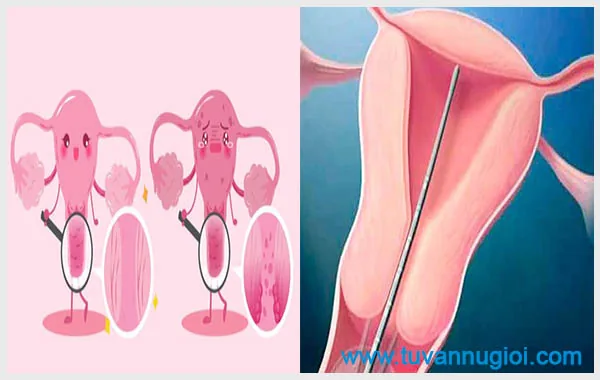 Có nhiều nguyên nhân gây cổ tử cung ngắn