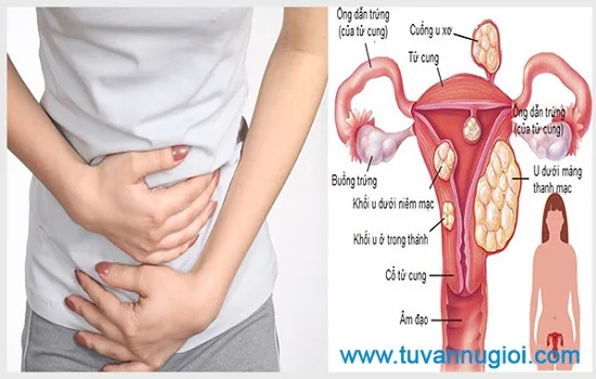 Hãy điều trị viêm phần phụ càng sớm càng tốt