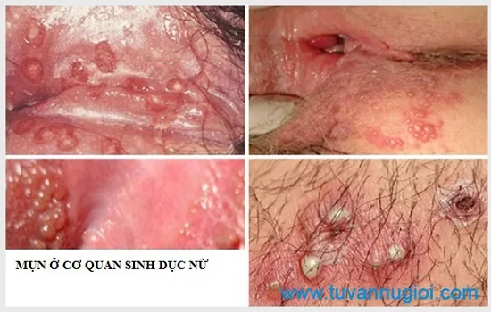 Bị mọc mụn ở bộ phận sinh dục nữ là dấu hiệu nhiều bệnh khác nhau