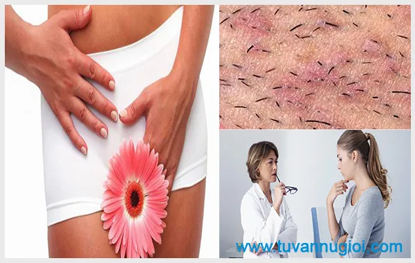 Cần điều trị sớm tình trạng ngứa môi lớn ở vùng kín