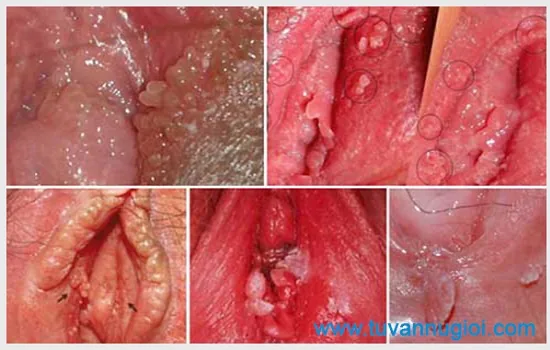 Cần kịp thời phát hiện triệu chứng bệnh sùi mào gà ở nữ