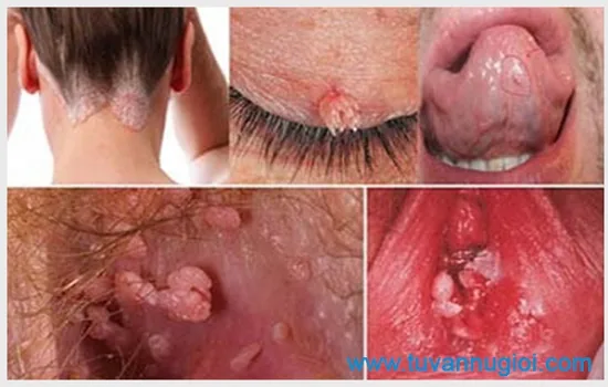 Cần kịp thời điều trị bệnh sùi mào gà ở nữ