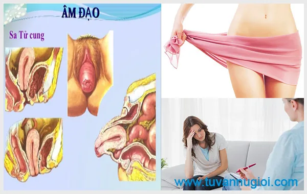 Cần sớm chữa bệnh sa tử cung