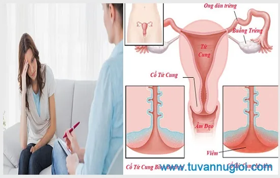 Cần kịp thời điều trị viêm phần phụ