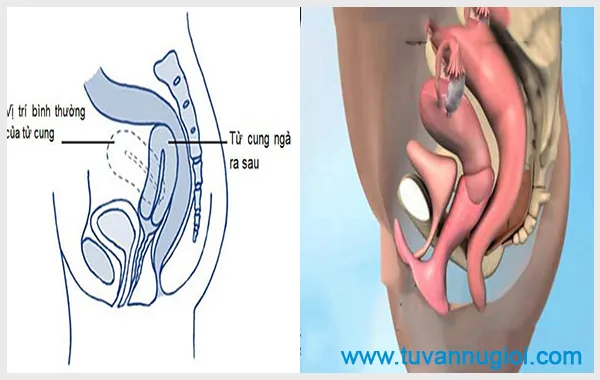 Tử cung ngã về phía sau cũng khá phổ biến