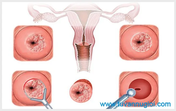 Hình ảnh mô phỏng viêm lộ tuyến các cấp độ khác nhau