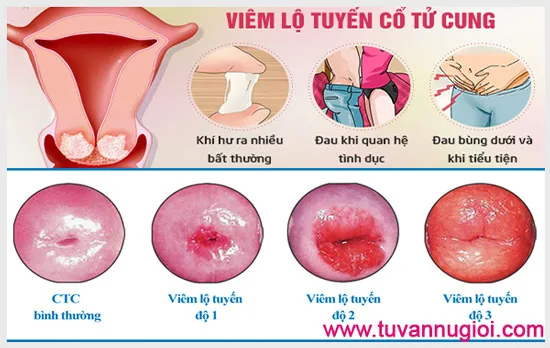 Viêm lộ tuyến tử cung có nguy hiểm không? – ảnh 1