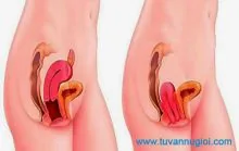 Ảnh minh họa bài: Cùng Phòng khám Đa khoa Hoàn Cầu tìm hiểu cục thịt chẩn ở cửa mình sau sinh có sao không?