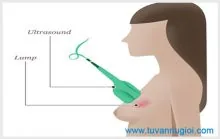 Ảnh minh họa bài: Siêu âm vú có chính xác bệnh không ?